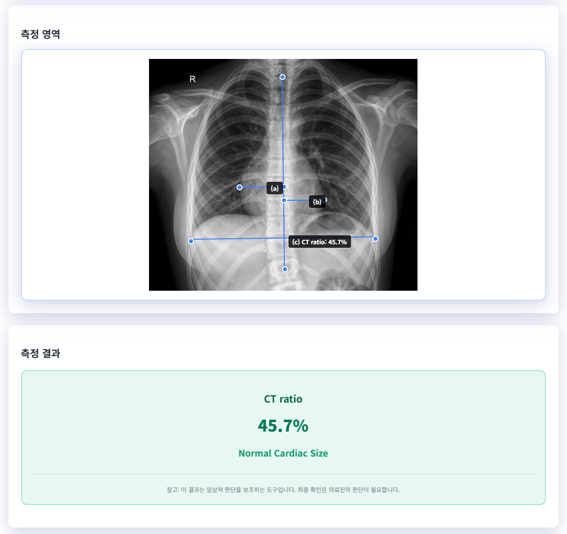 흉부 X-ray CT ratio 측정기 (CardioThoracic Ratio) - 의학계산기